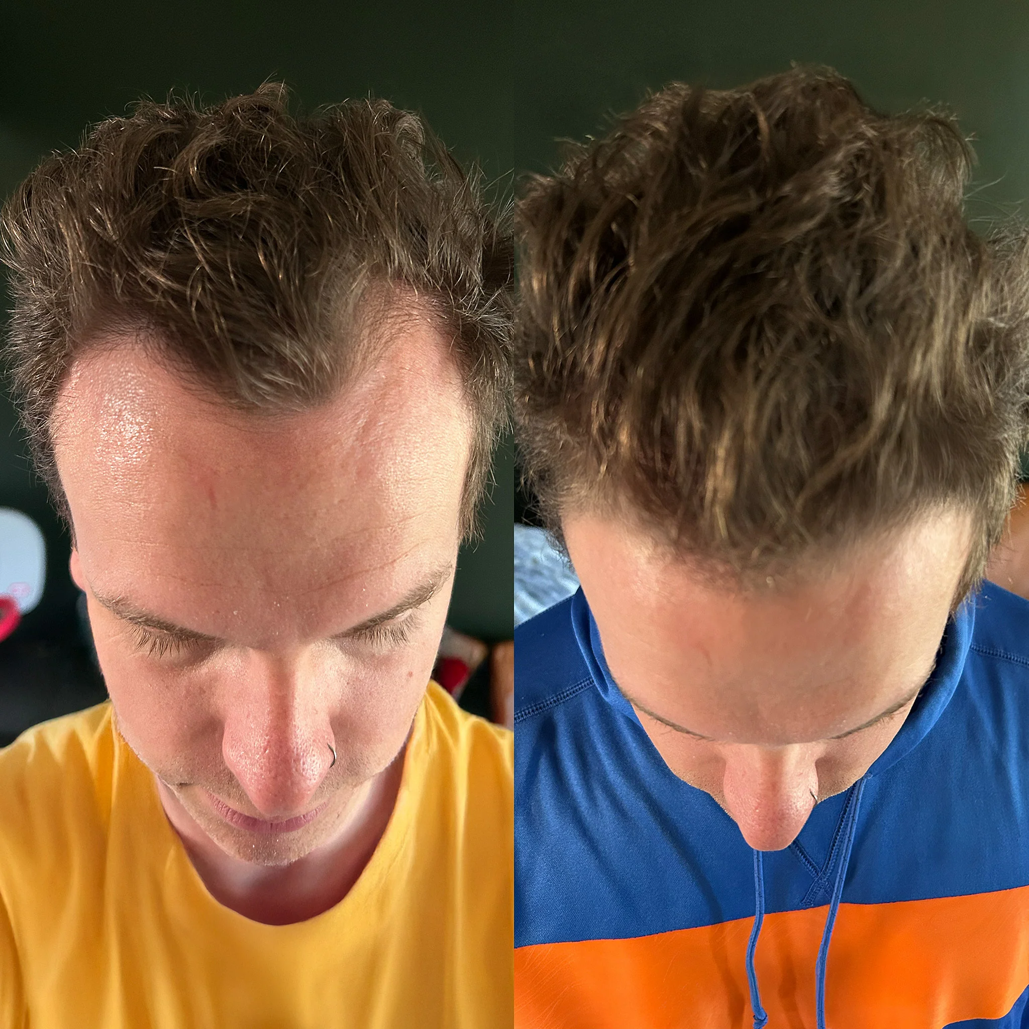 Before and After Results 3